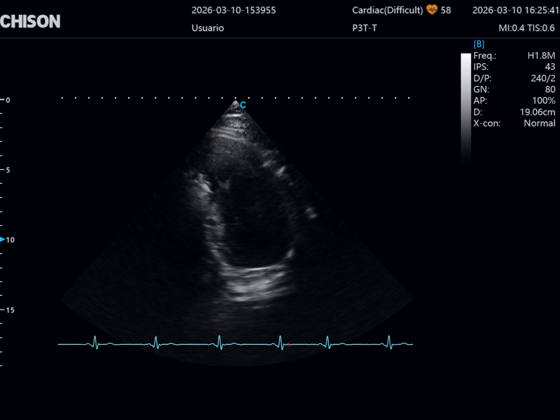 la nueva generación de ultrasonidos